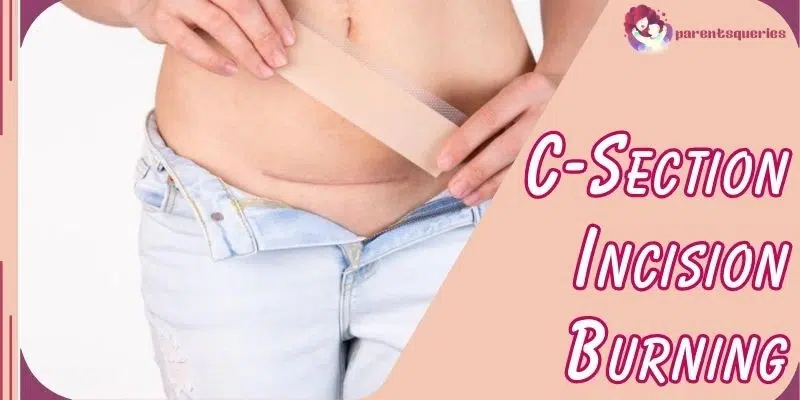 C Section Incision Burning What S Normal When To Worry   C Section Incision Burning.webp